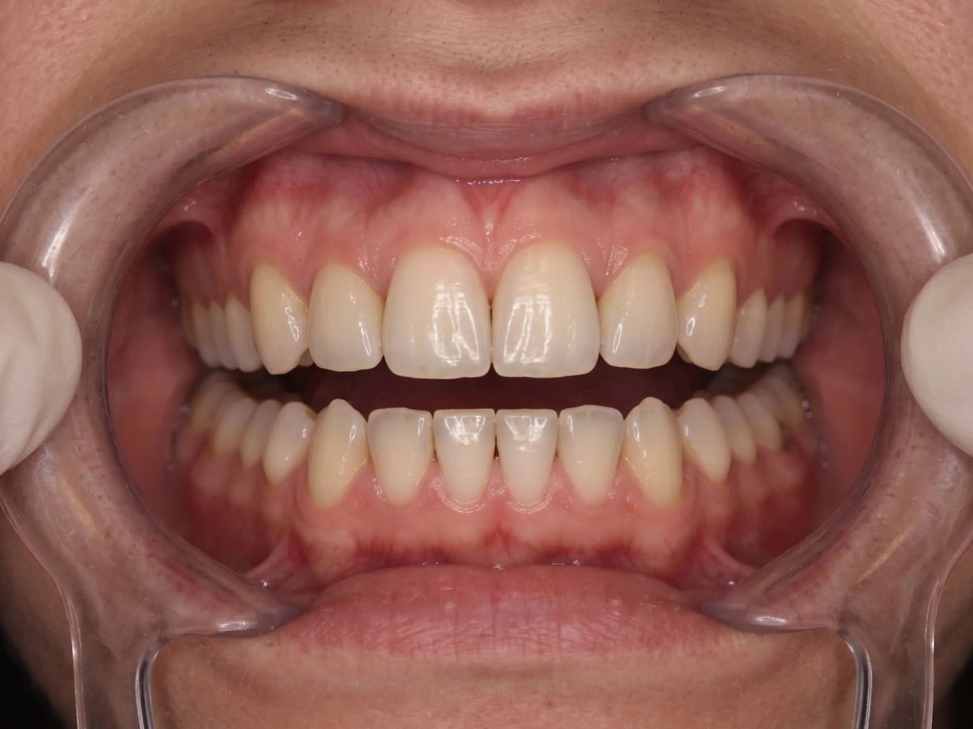 Case 031, After