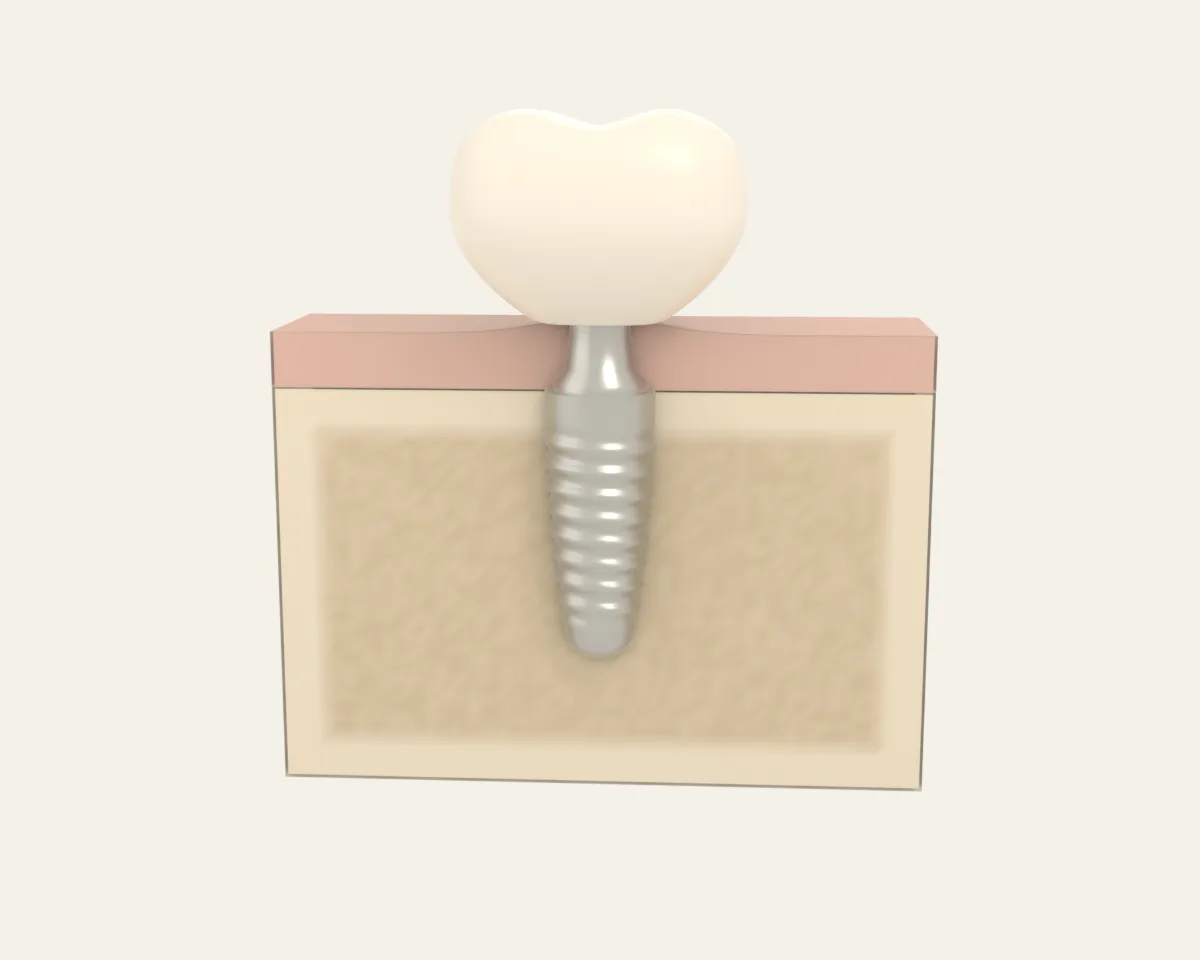 Illustration poster for Implants and full arch